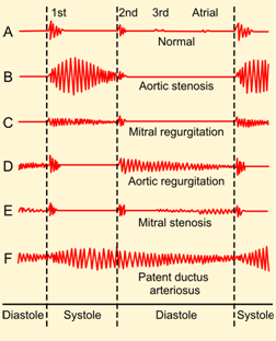 https://upload.wikimedia.org/wikipedia/commons/4/4a/Phonocardiograms_from_normal_and_abnormal_heart_sounds.png
